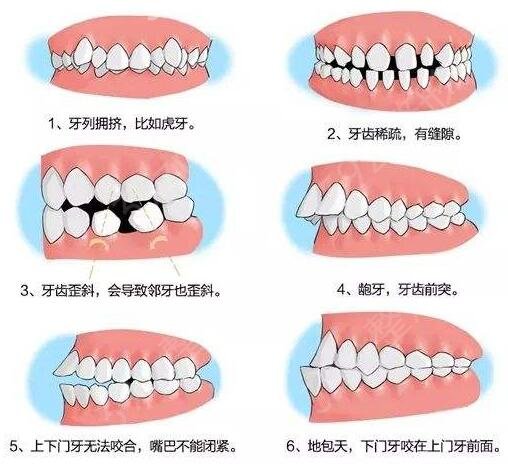 5类人不能做牙齿整形