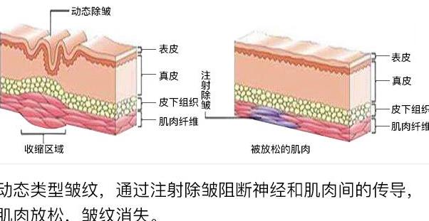 除皱