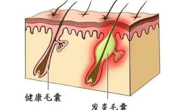 毛囊炎