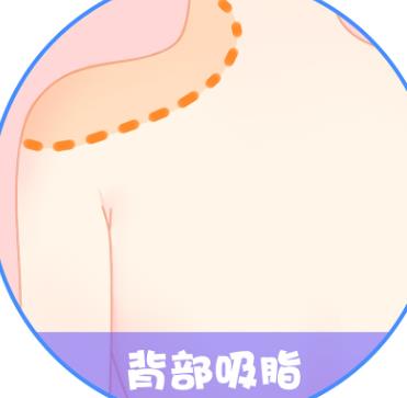 背部吸脂