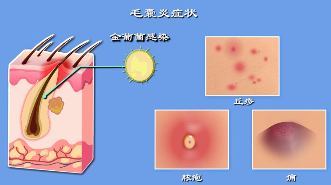 毛囊炎