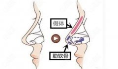 肋骨隆鼻的果是的吗？