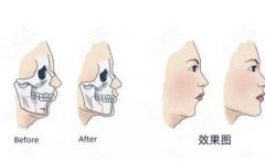 必看篇！正颌骨手术千万别去做?正颌手术对人一辈子的影响?