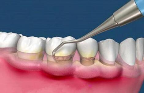 牙周刮治疗