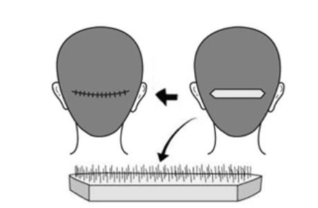 头顶植发