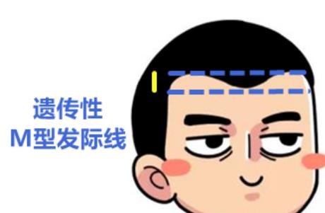 m型发际线