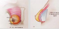 乳房下垂矫正术后护理怎么做?术后需注意什么事项