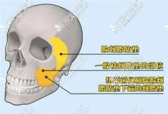 去颊脂垫瘦脸大概费用多少钱