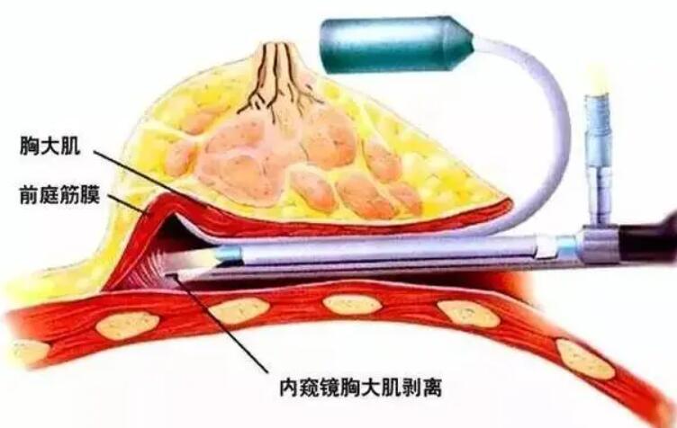 内窥镜假体隆胸