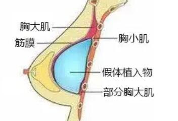 内窥镜假体隆胸