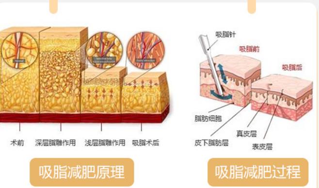 水动力吸脂术