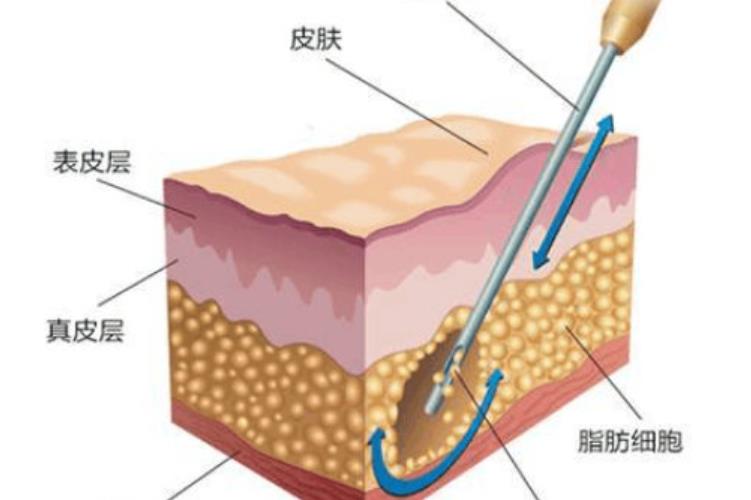 水动力吸脂术