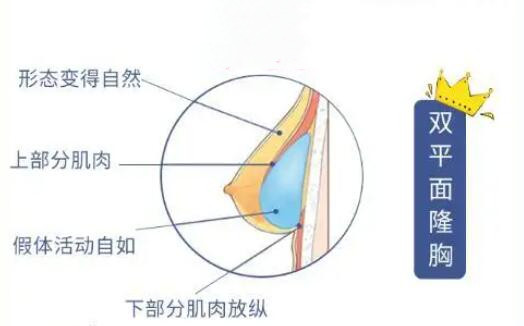 娜高假体隆胸需要多少钱?