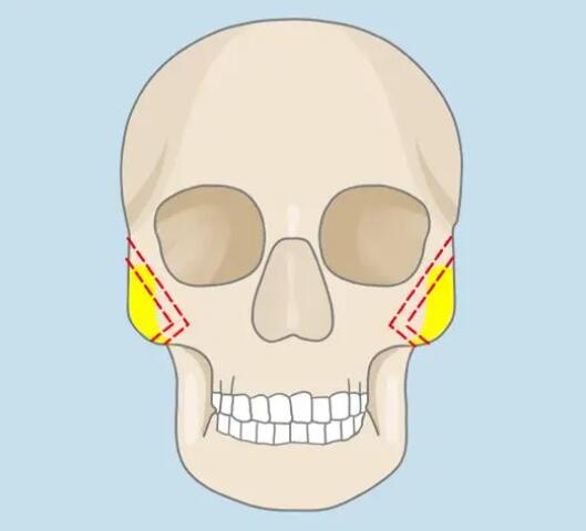 前颧骨低怎么办?
