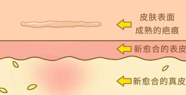 有伤疤怎么去掉比较快？通过这3个小技巧来改善！