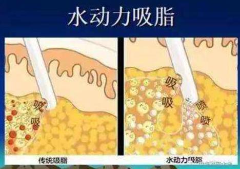 水动力吸脂