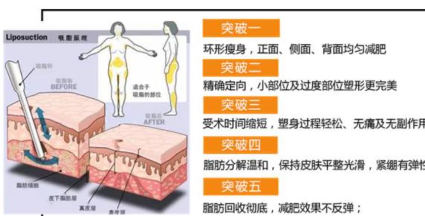 水动力吸脂