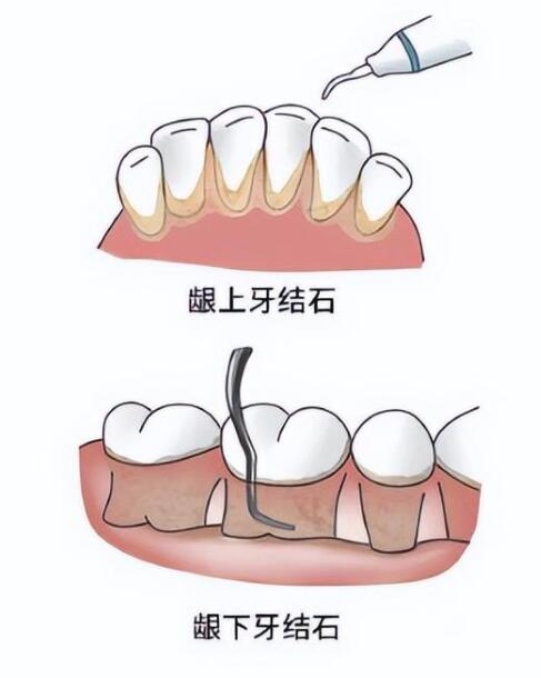 刮治牙周后需要注意的事项有哪些?