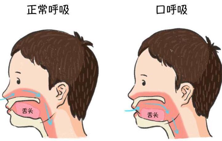 如何预防用嘴巴呼吸的情况?