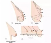 如何挽救乳房下垂?乳房下垂矫正的方法是什么