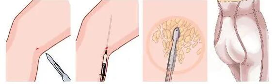 臀部吸脂手术原理介绍