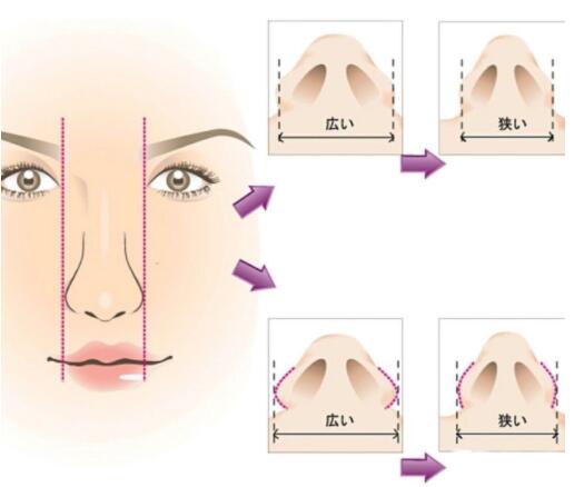 鼻翼变大怎么办?