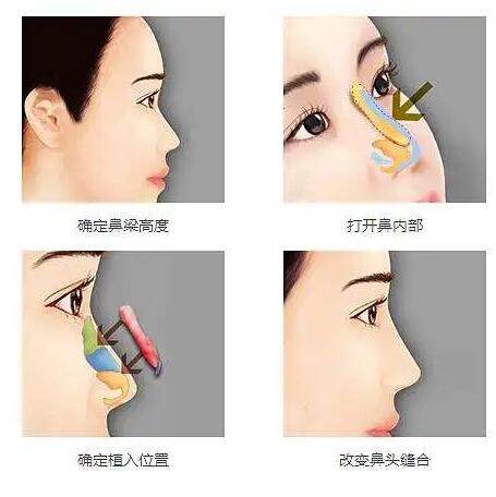 美国射极峰和菲思挺膨体隆鼻区别