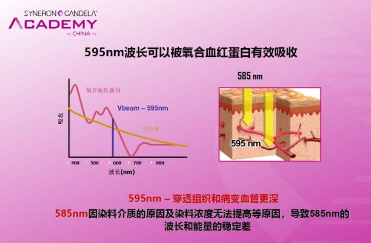 赛诺龙595染料激光好吗?