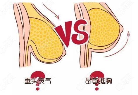 乳房悬吊术可以维持多久?