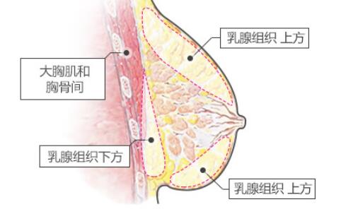 做了乳房悬吊之后需要注意什么?