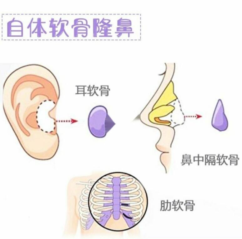 只做耳软骨垫鼻尖不放假体可以吗?