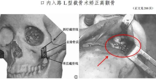 颧骨内推的手术风险高吗?