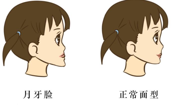 下巴前突改善方法