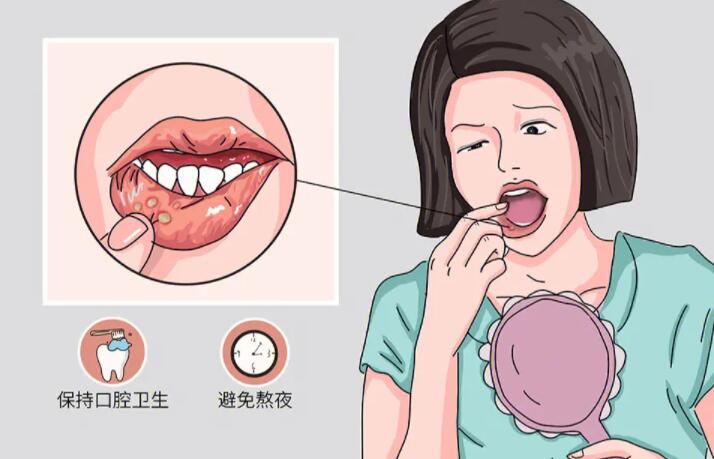 口腔溃疡反复发作或存在消化道疾病！牙医与消化科医生现身科普~