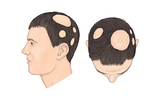 斑秃治疗方法有那些?