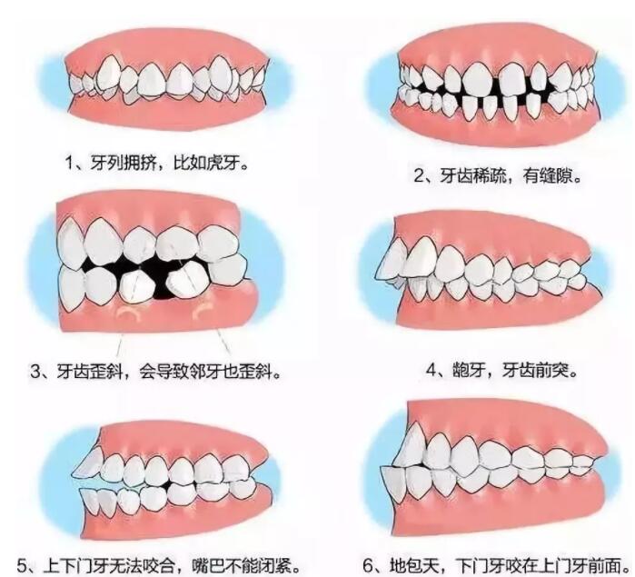 传统矫正牙齿后需要注意的事项有哪些?