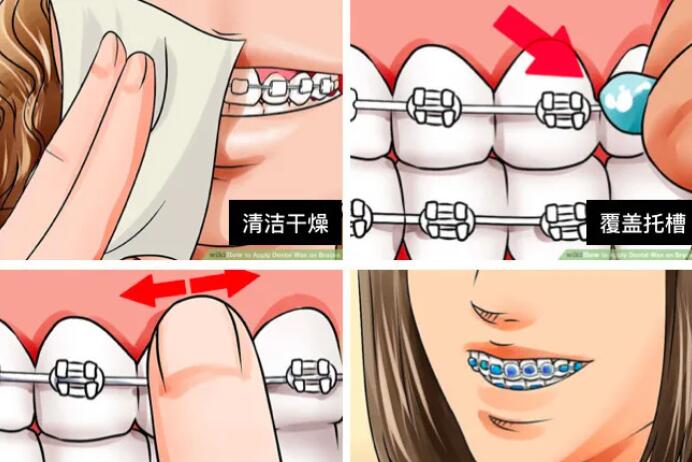 牙齿矫正的介绍