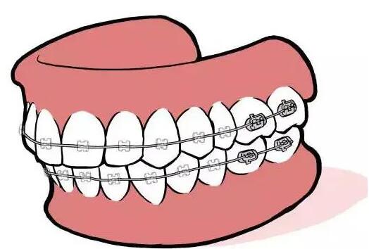 牙齿矫正的注意事项