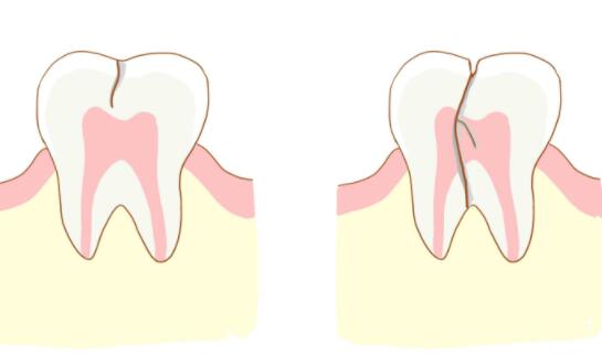 牙齿表面有裂纹的解决办法