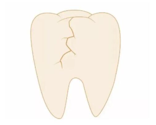 牙齿裂纹的预防