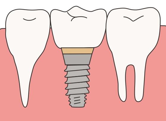 种植牙的介绍