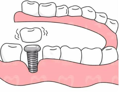 种植牙的介绍