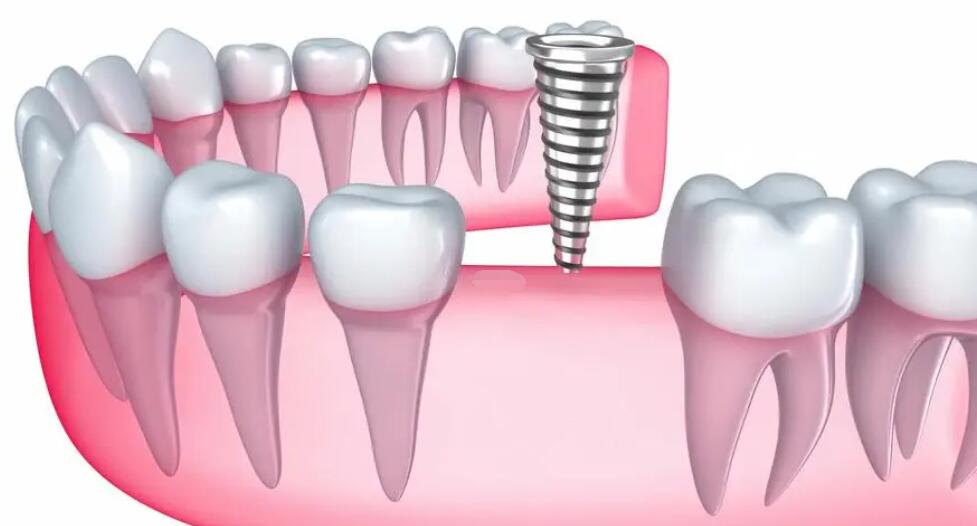 种植牙的注意事项