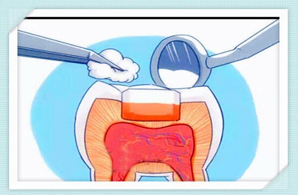 补牙的注意事项