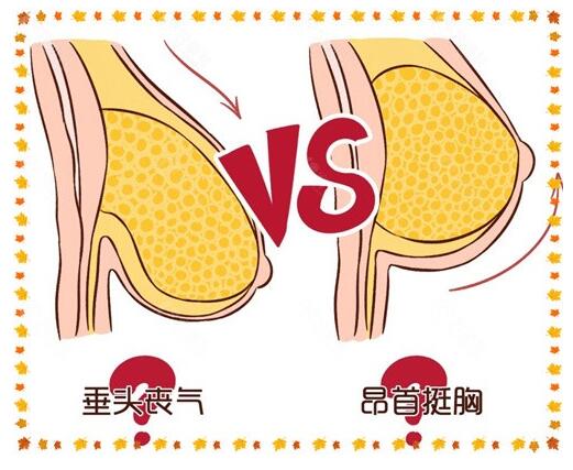 乳房下垂松软怎么办?