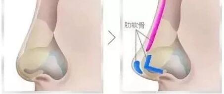 硅胶和膨体材质安全吗?