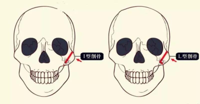 颧骨结构解析