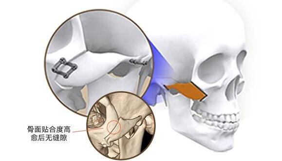 颧弓外扩怎样矫正比较好?