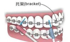 牙齿矫正器mrc和t4k的区别本质，各自优势盘点一下~