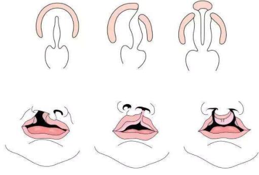 兔唇的检查及改善